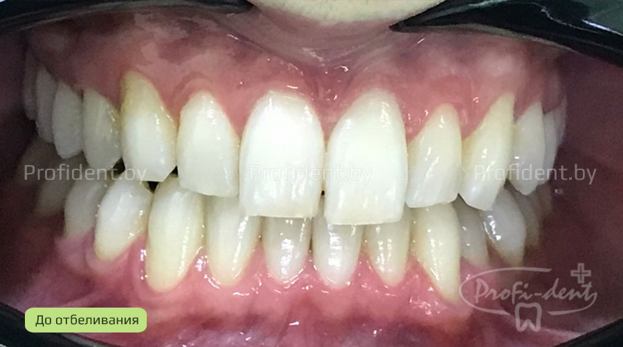Фото-ультразвуковое отбеливание зубов с использованием аппарата Beyond Polus