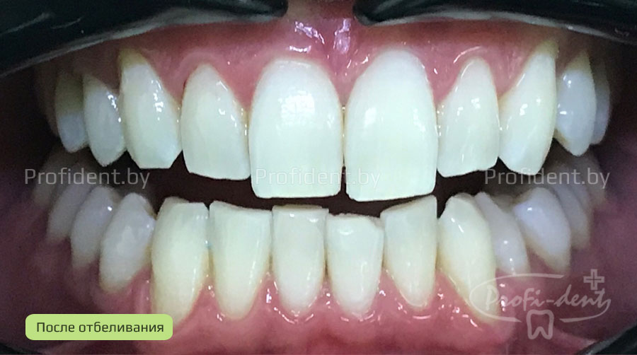 Фото-ультразвуковое отбеливание зубов с использованием аппарата Beyond Polus