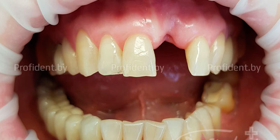 Временное восстановление дефекта зубного ряда адгезивным протезом
