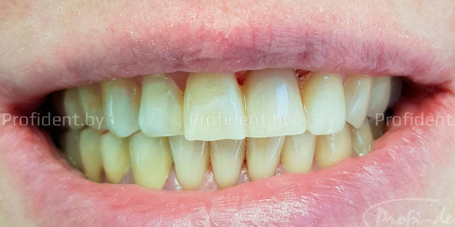 Временное восстановление дефекта зубного ряда адгезивным протезом