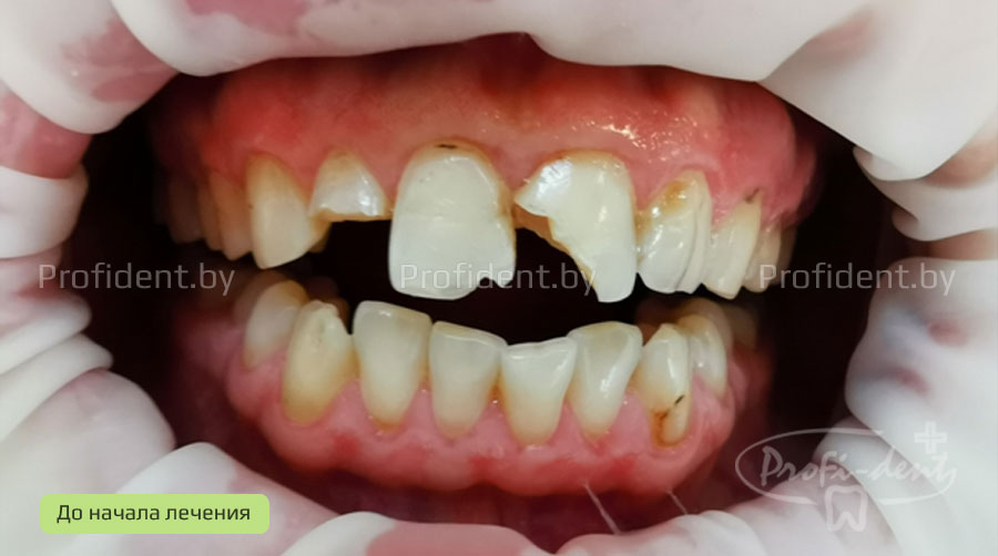 Восстановление передних зубов после травмы