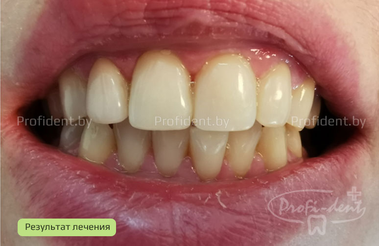 Восстановление передних зубов после травмы