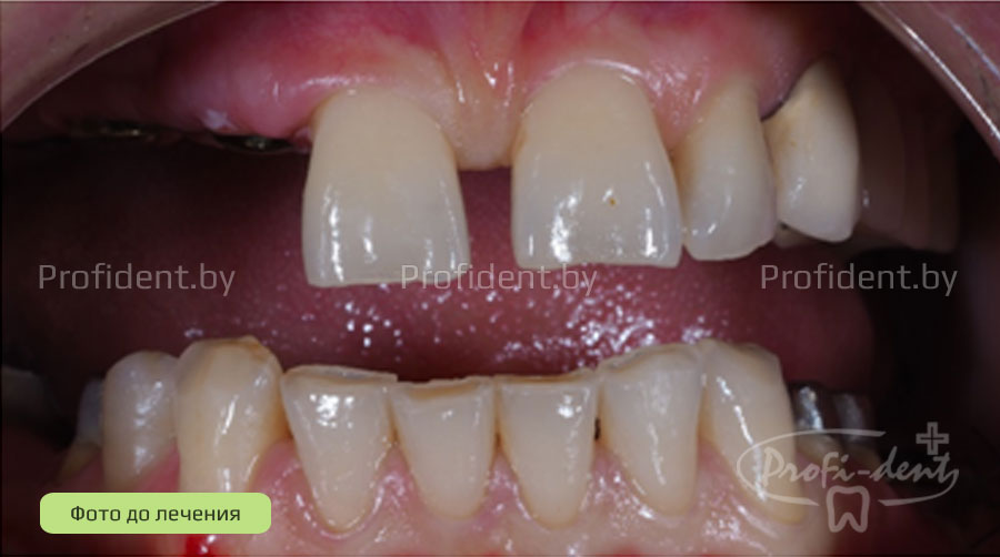 Полная реабилитация пациента с частичным отсутствием зубов