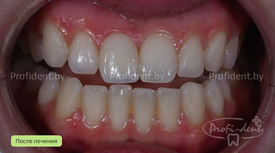 Керамическая реставрация переднего зуба