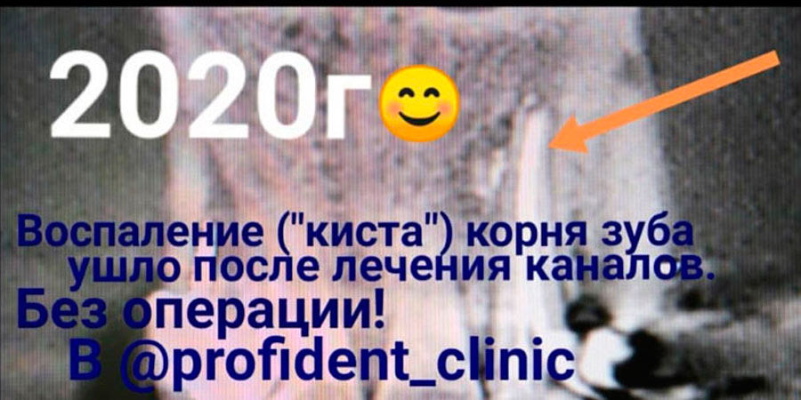 Лечение каналов зуба