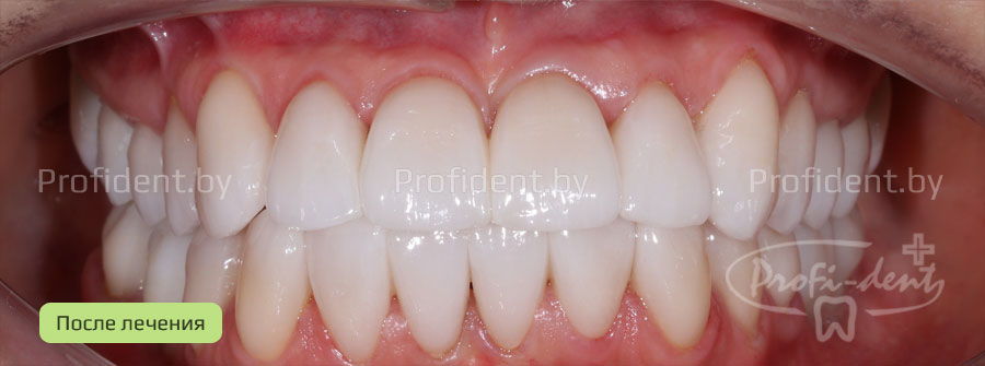 Керамические реставрации и коронки из оксид циркония и E-max