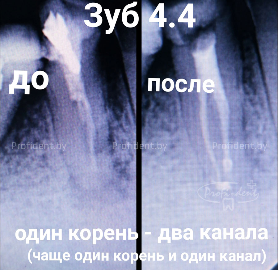 Лечение зубов с нетипичной анатомией корневых каналов