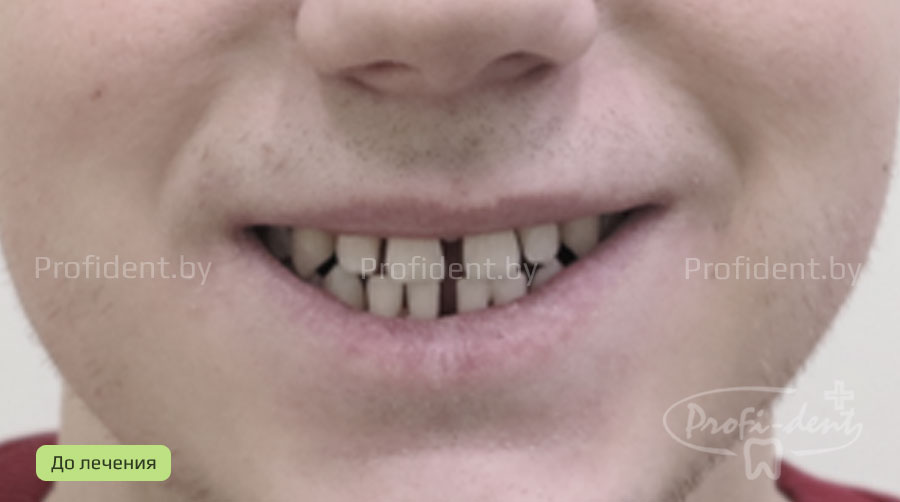 Устранение щелей между зубами путем ортодонтического лечени