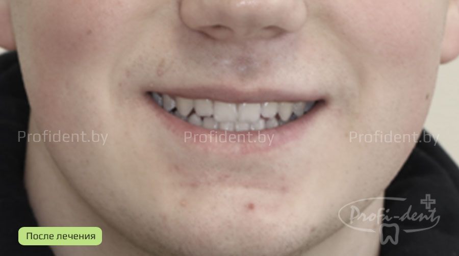 Устранение щелей между зубами путем ортодонтического лечени