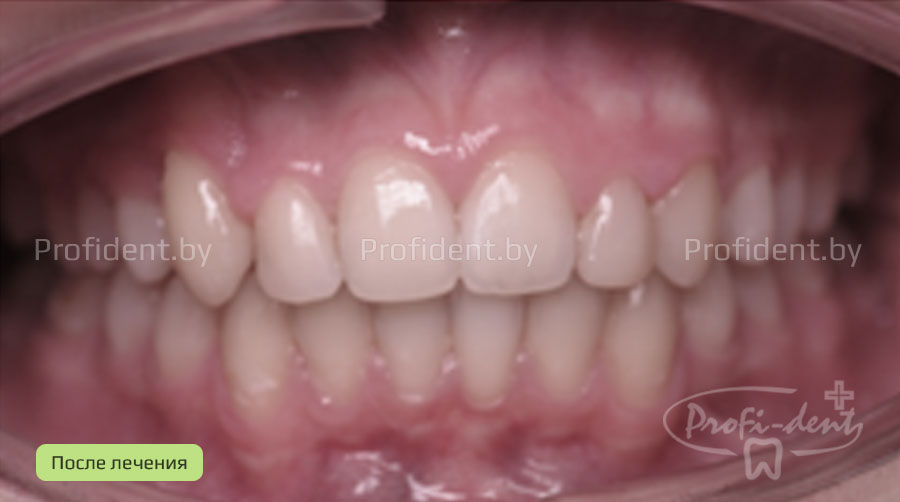 Исправление сложной аномалии положения зубов брекет системой и эстетическими реставрациями