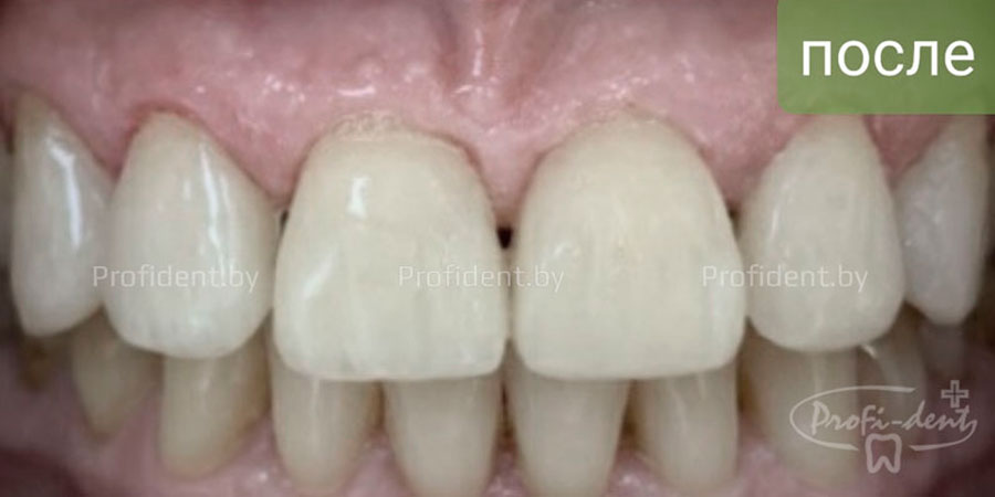 Устранение щели между передними зубами