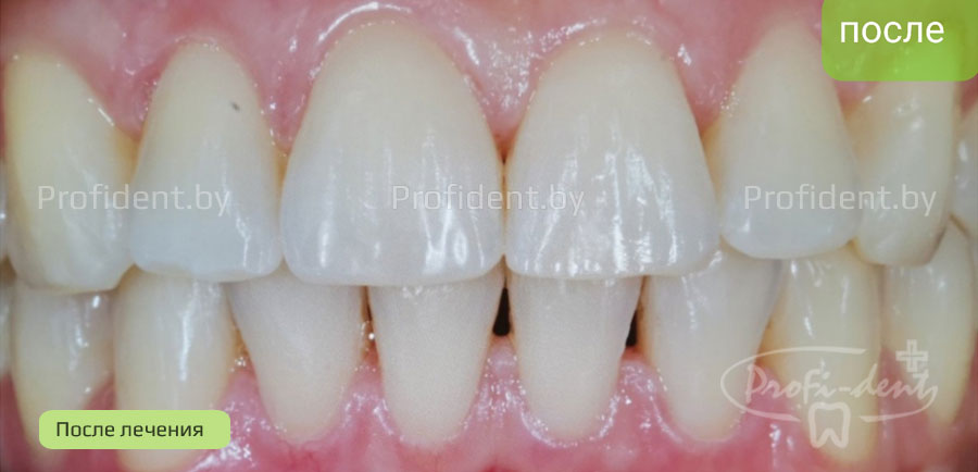 Ортодонтическое лечение и имплантация зубов