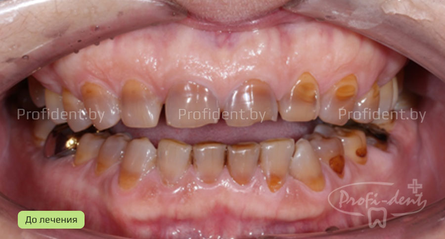 Виниры: устранение сколов и потемнений зубов