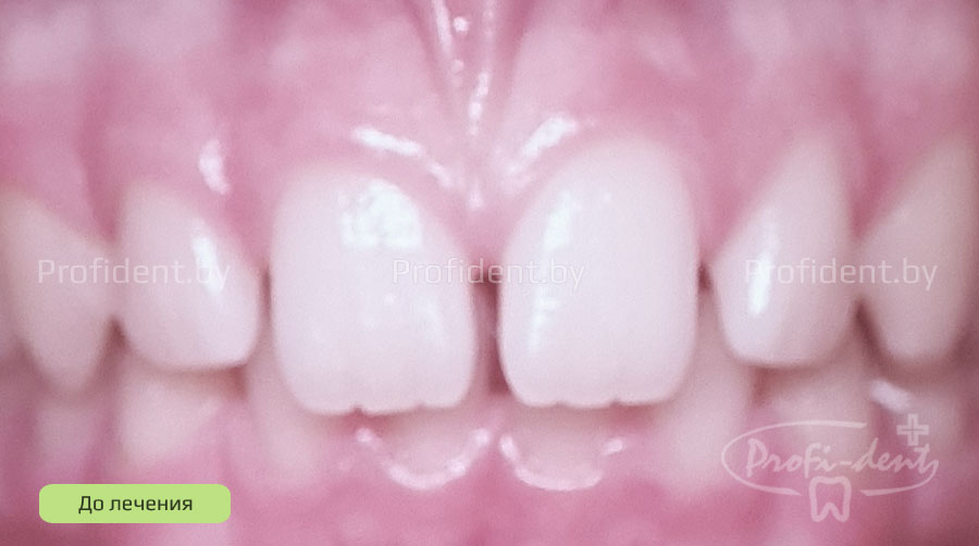 Устранение щели между зубами и исправление прикуса