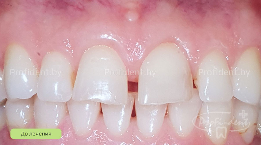 Устранение щели(диастемы) между зубами