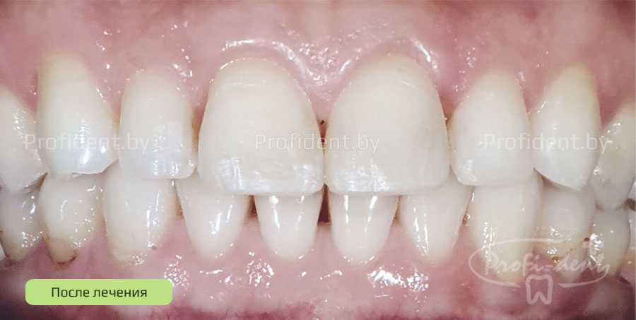 Устранение щели(диастемы) между зубами