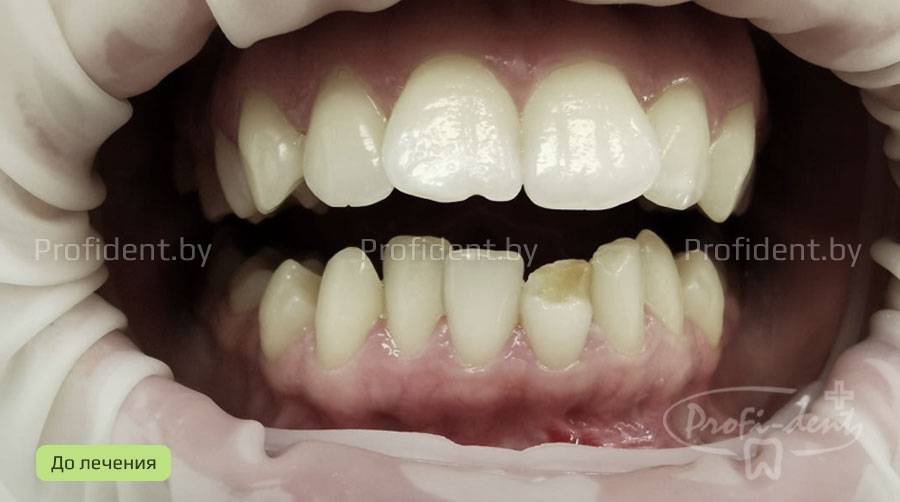 Восстановление эстетики переднего зуба