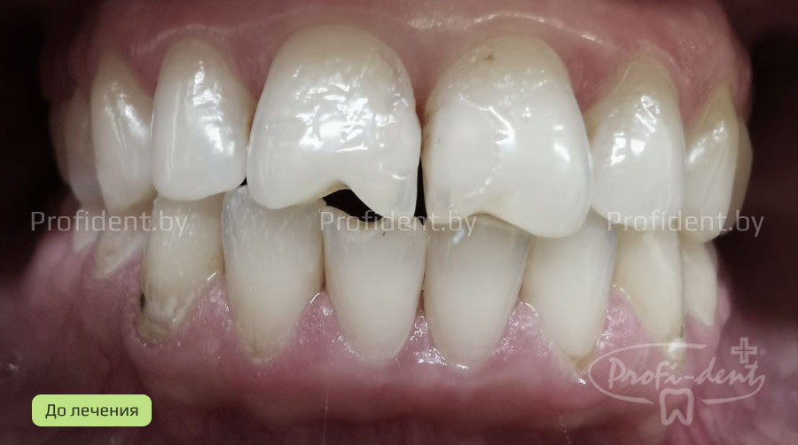 Восстановление эстетики переднего зуба