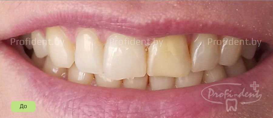 Внутрикоронковое отбеливание и реставрация режущего края зубов