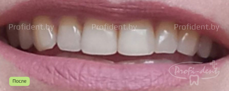 Внутрикоронковое отбеливание и реставрация режущего края зубов