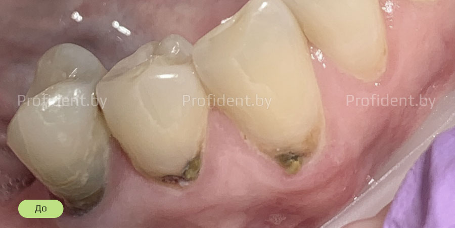 В результате лечения кариес был удален и коронка зубов востановленна современным фотокомпозитным материалом. Фотографии до и после лечения представлены ниже.