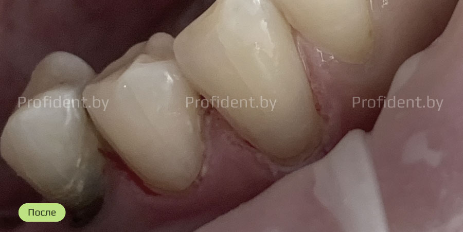 В результате лечения кариес был удален и коронка зубов востановленна современным фотокомпозитным материалом. Фотографии до и после лечения представлены ниже.