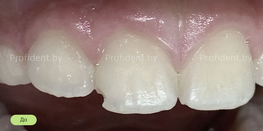 Реставрация переднего зуба фотокомпозитом