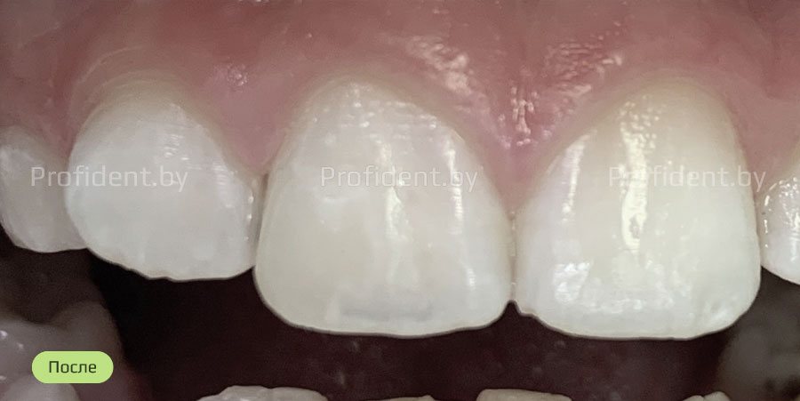 Реставрация переднего зуба фотокомпозитом