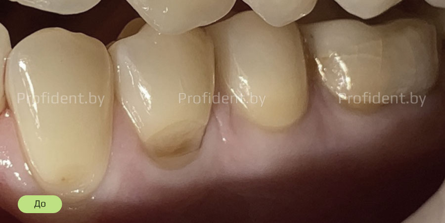 Закрытие клиновидного дефекта зуба фотокомпозитом