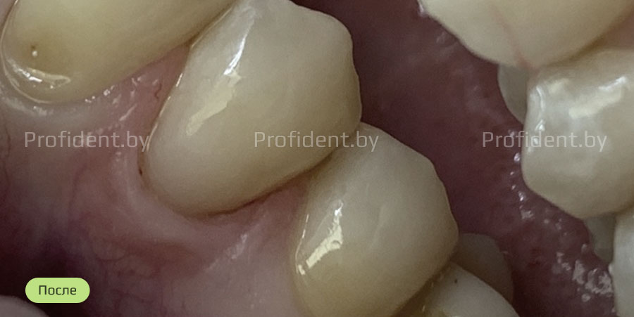 Закрытие клиновидного дефекта зуба фотокомпозитом