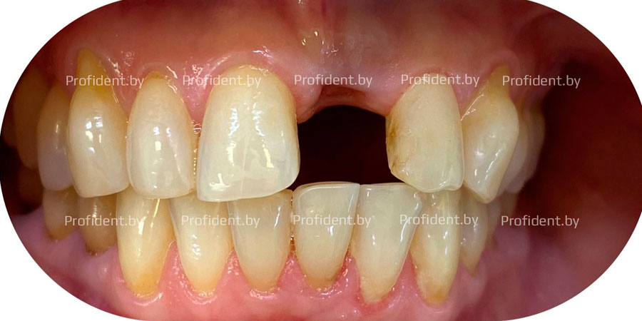 Адгезивный протез зуба 2.1
