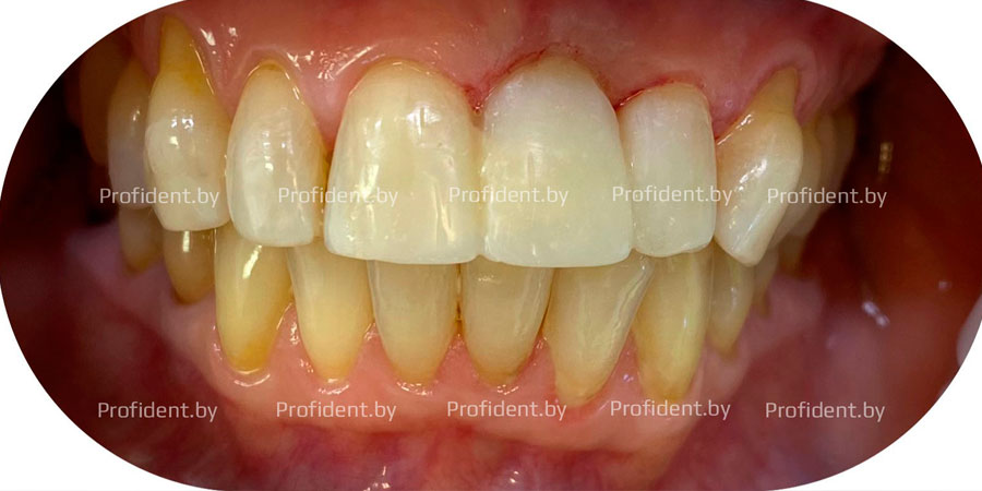 Адгезивный протез зуба 2.1