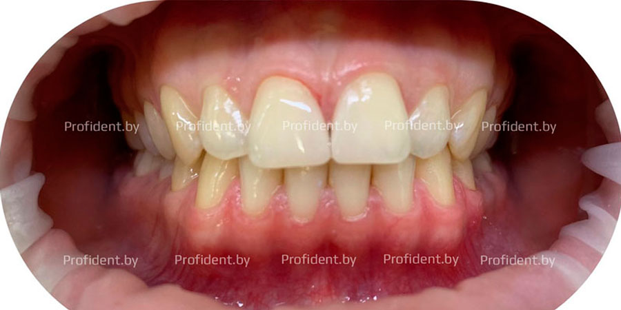 Закрытие промежутка между передними зубами