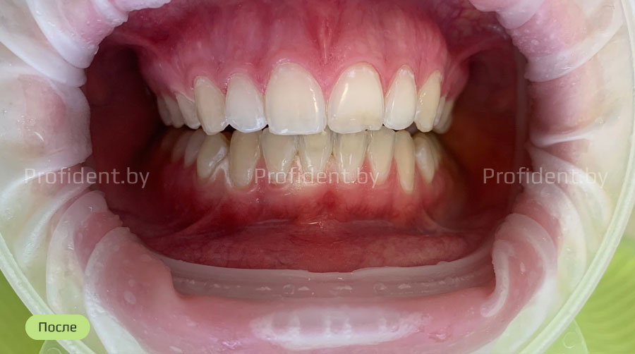 Фотоотбеливание зубов Beyond Polus