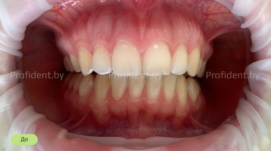 Фотоотбеливание зубов Beyond Polus