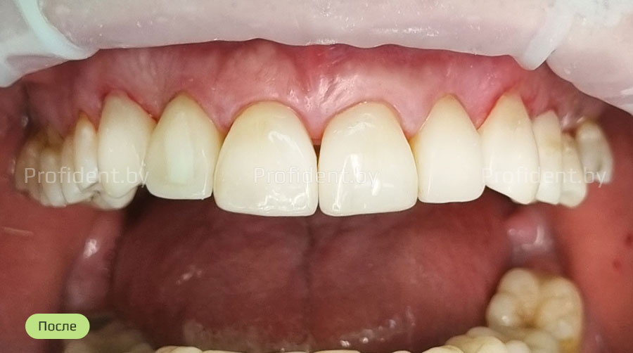Восстановление передних зубов винирами