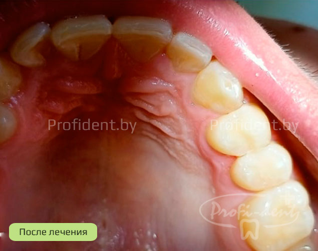 Лечение кариеса зубов 2.4 и 2.5