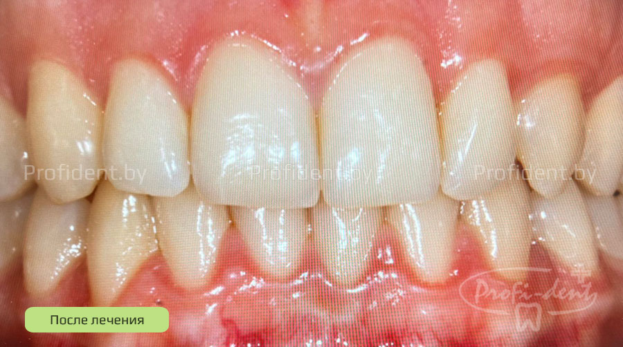 Исправление скученности зубов на обеих челюстях