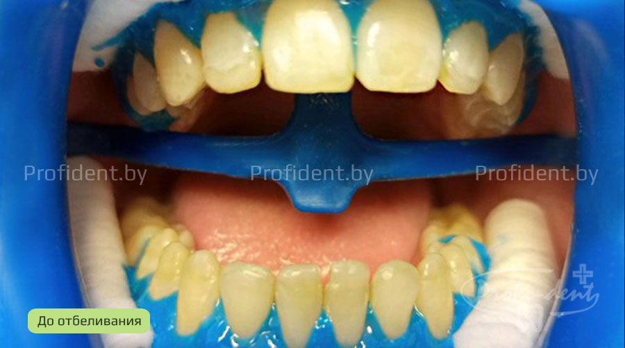 Фотоотбеливание зубов Beyond Polus до и после
