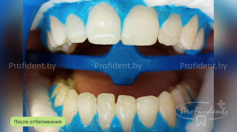 Фотоотбеливание зубов Beyond Polus до и после