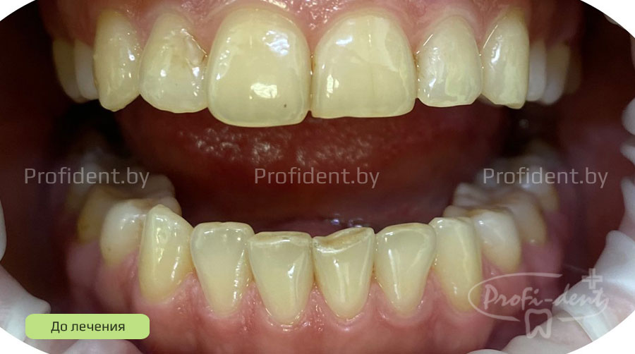 Фотоотбеливание и реставрация передних зубов