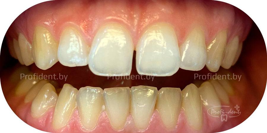 Закрытие диастемы зубов 11 и 21