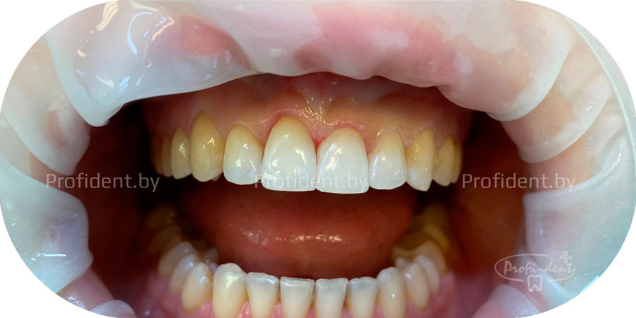 Отбеливание и реставрация передних зубов