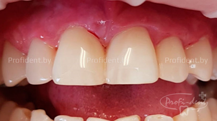 Лечение периодонтита и эстетическая реставрация передних зубов
