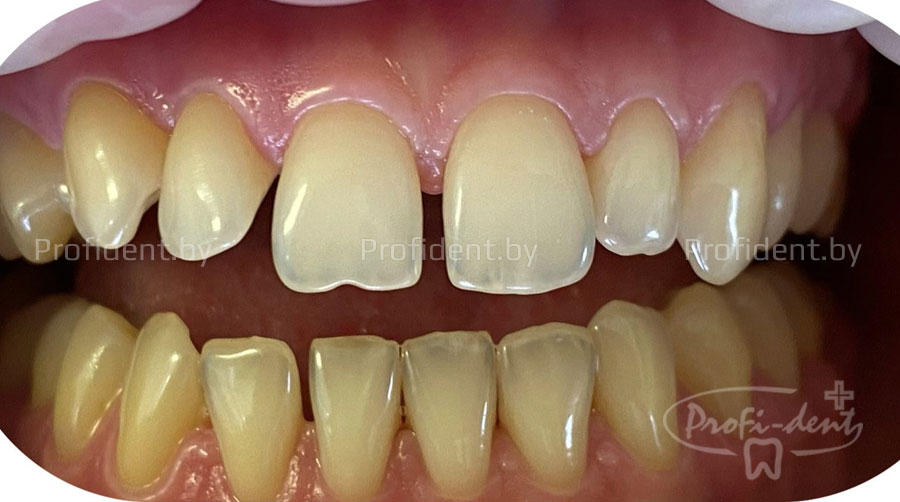 Отбеливание и реставрация передних зубов