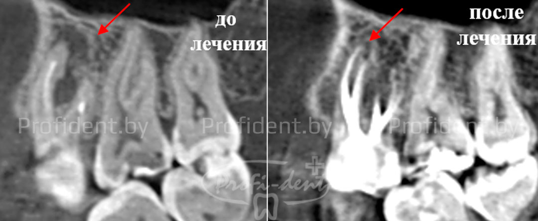 Пломбирование каналов зубов с воспалительным очагом на верхушке корня