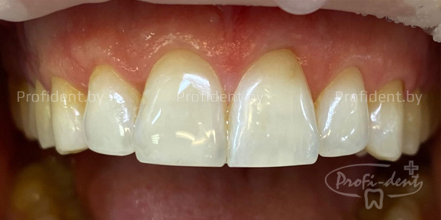 Эстетическая реставрация зубов после травмы