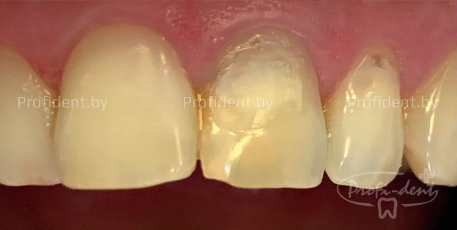 Замена дефектной пломбы в зубе 21