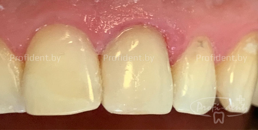Замена дефектной пломбы в зубе 21