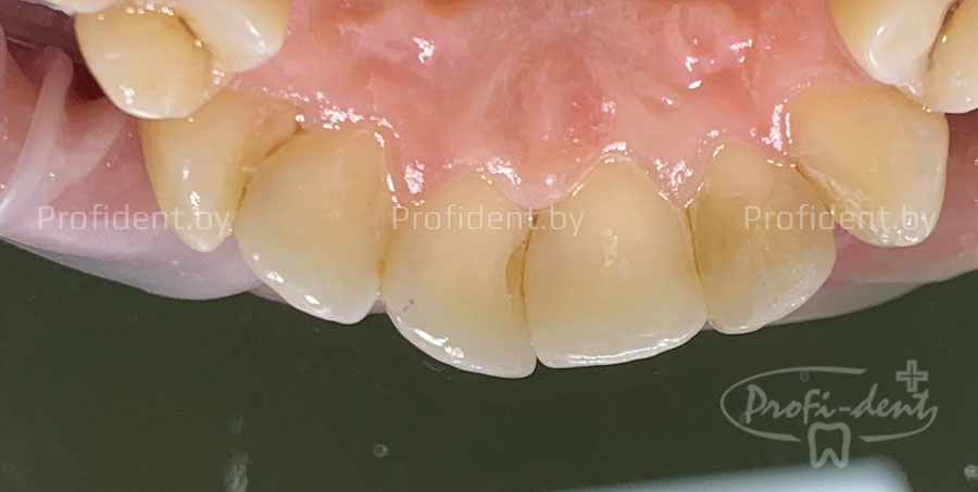 Замена дефектной пломбы в зубе 11
